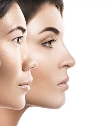 ethnic rhinoplasty istanbul turkey 1024x511 1 e1606145967436