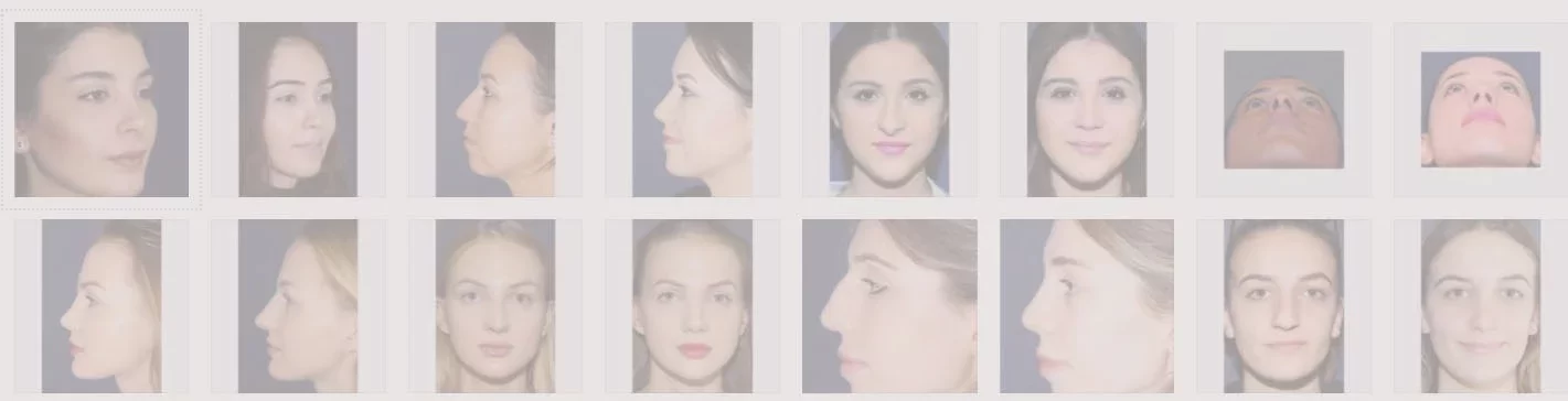 secondary rhinoplasty e1695064402185