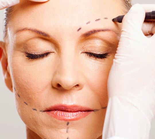 facelift